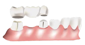 dental bridge - Medicaid Dentist in Grand Junction, CO