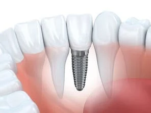 illustration of teeth and roots in gums, embedded dental implants Cockeysville, MD