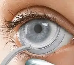 prokera membrane on eye