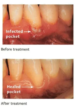 Infected pocket and healed pocket