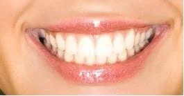 woman's smiling mouth, nice, uniform white teeth after dental bonding Magnolia, TX Dentist