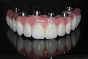 Stockton Dental Implants - Full Mouth