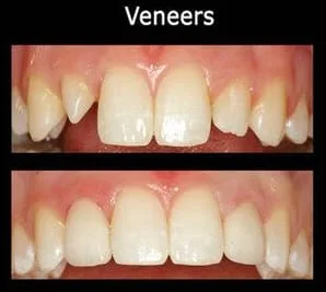 teeth before and after dental veneers Lake Stevens, WA family dentist