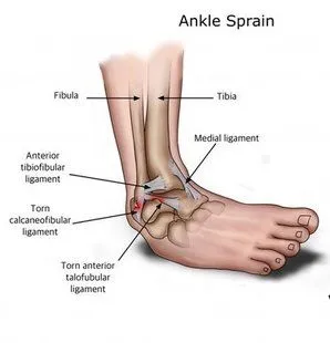 Ankle Sprain - Rockford, IL: Midwest Foot & Ankle Associates