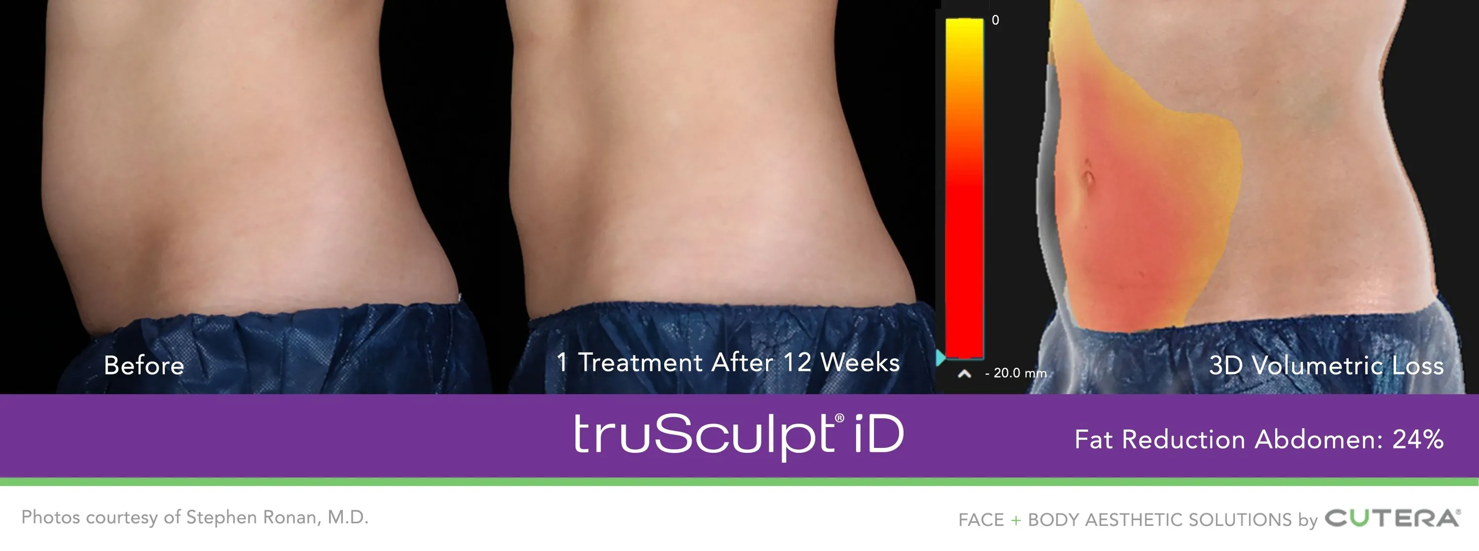 TRUSCULPT ID