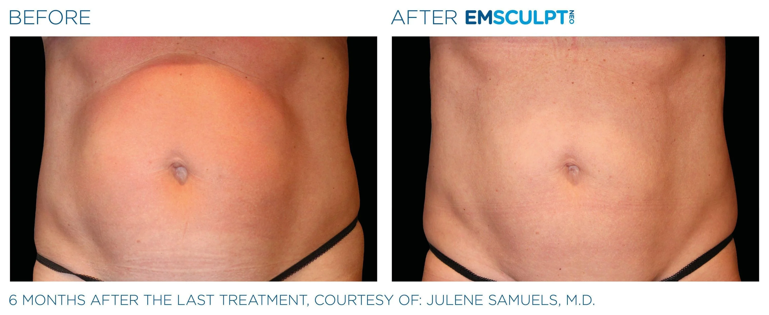 EmSculpt Neo Edge - Natura Dermatology