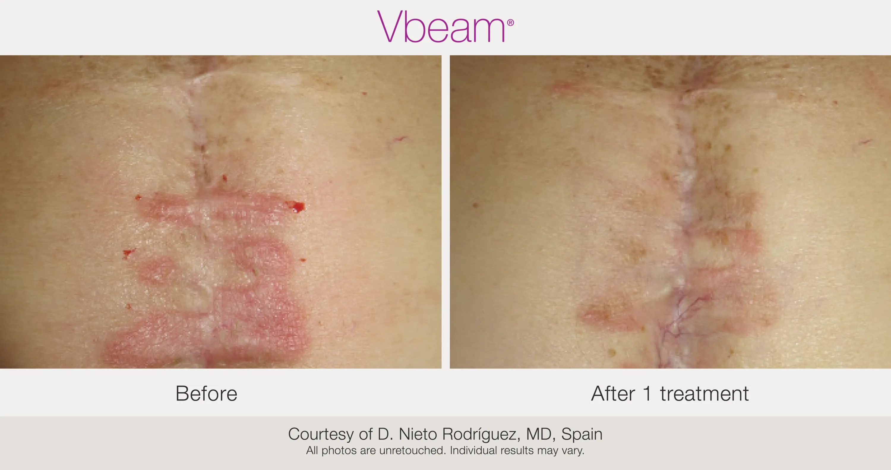 Before and After Vbeam