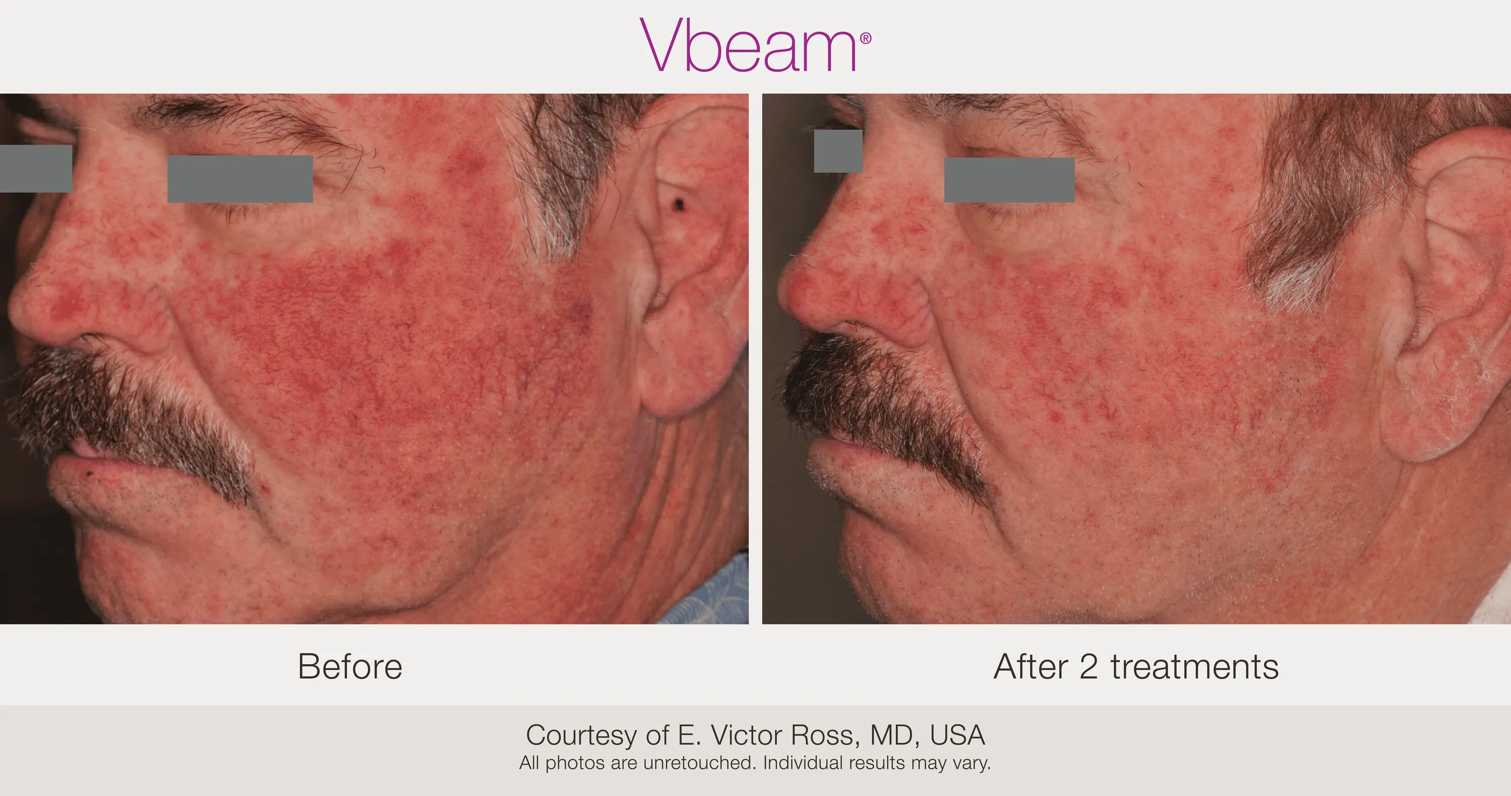 Before and After Vbeam