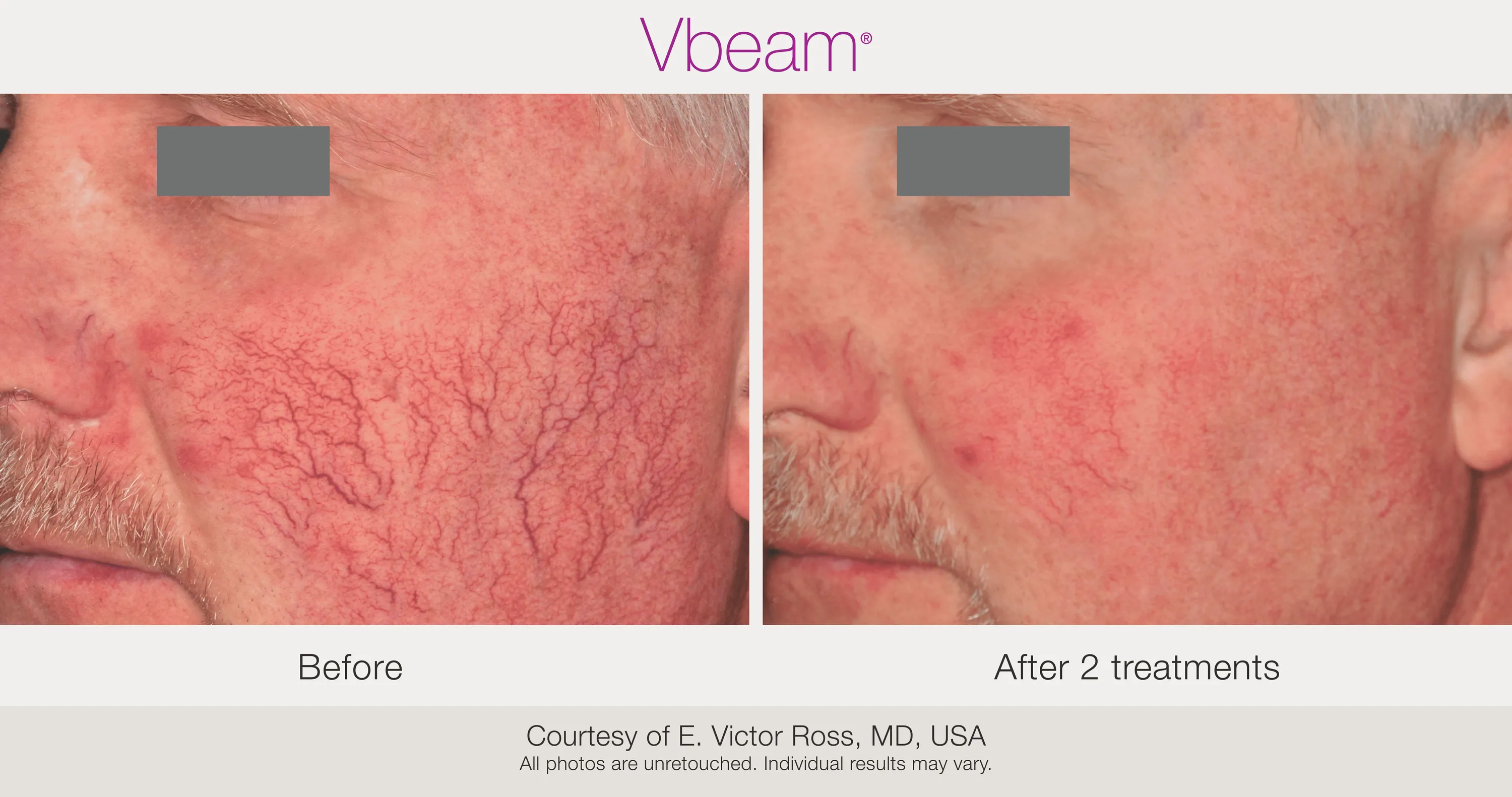 Before and After Vbeam