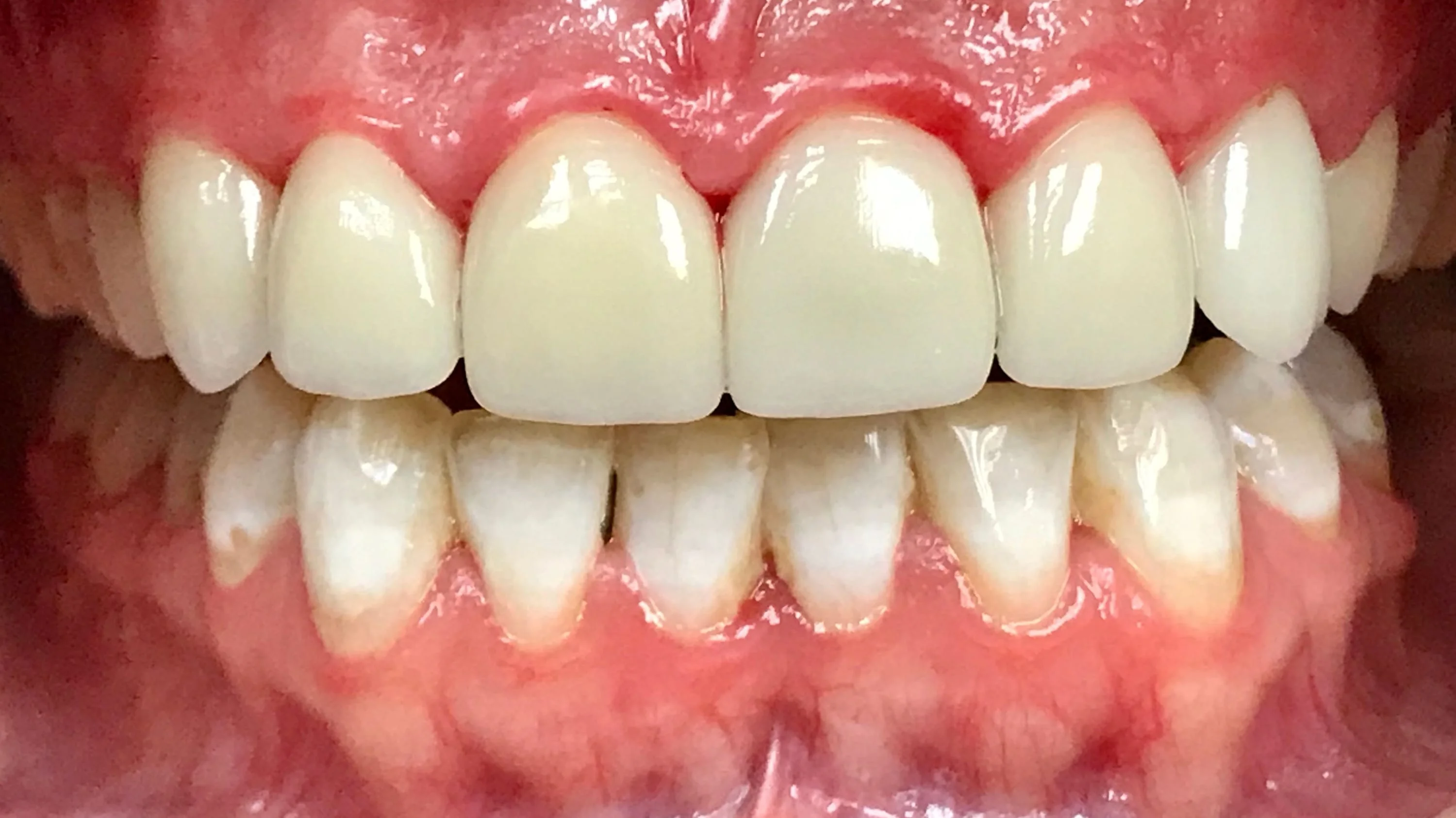 Smile Makeover (Emax Crowns)