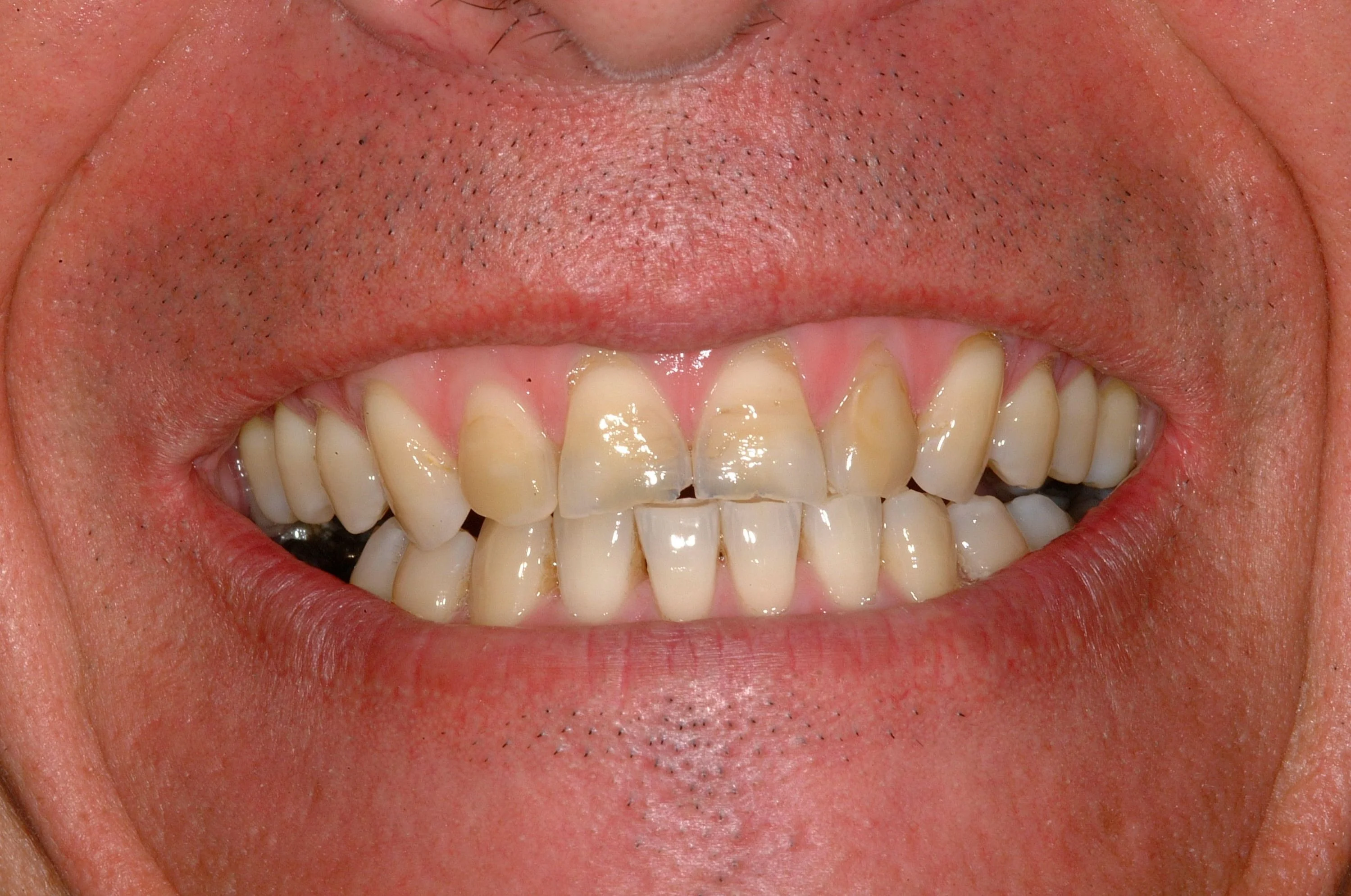 Corrected bite and worn teeth