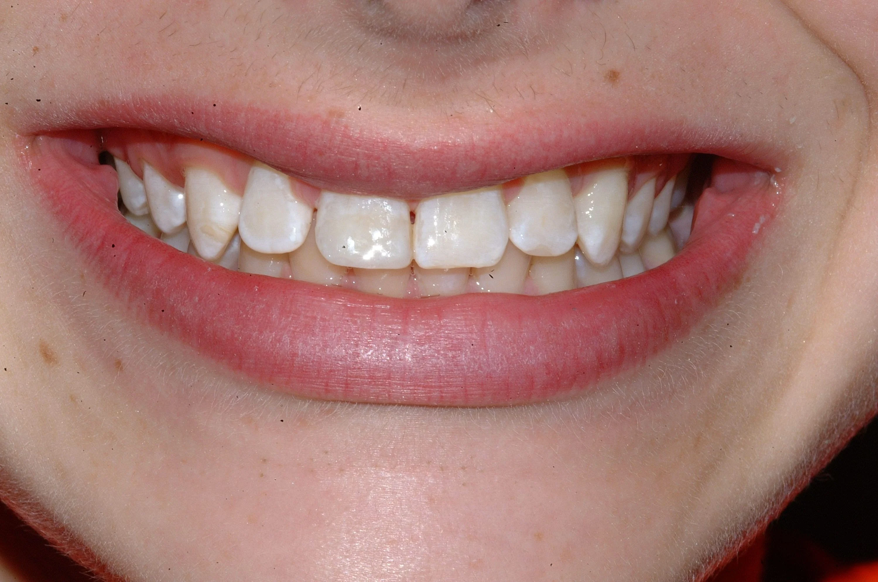 Front tooth composite