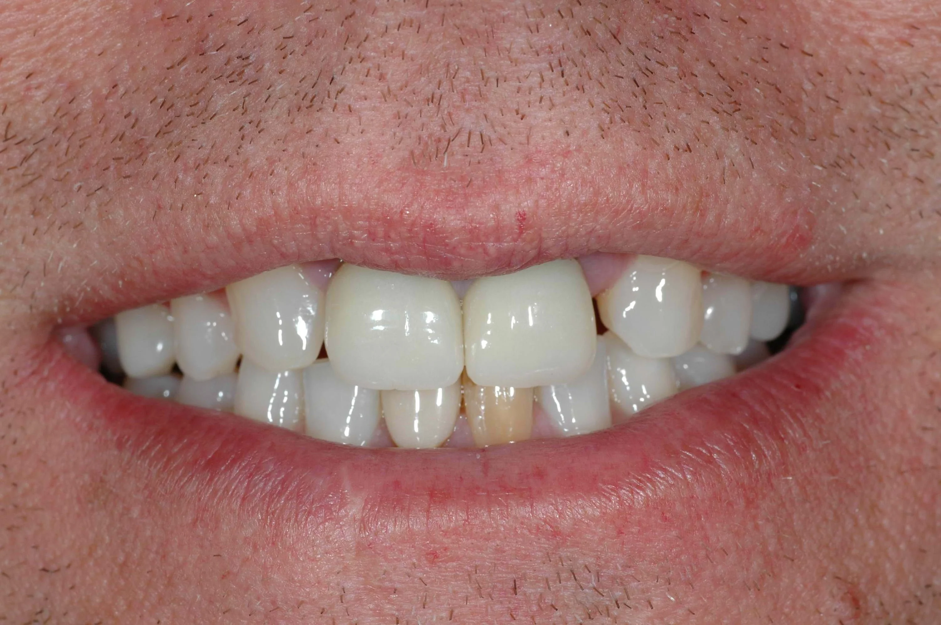 Cosmetic Dentistry McCandless Pittsburgh PA - before photo