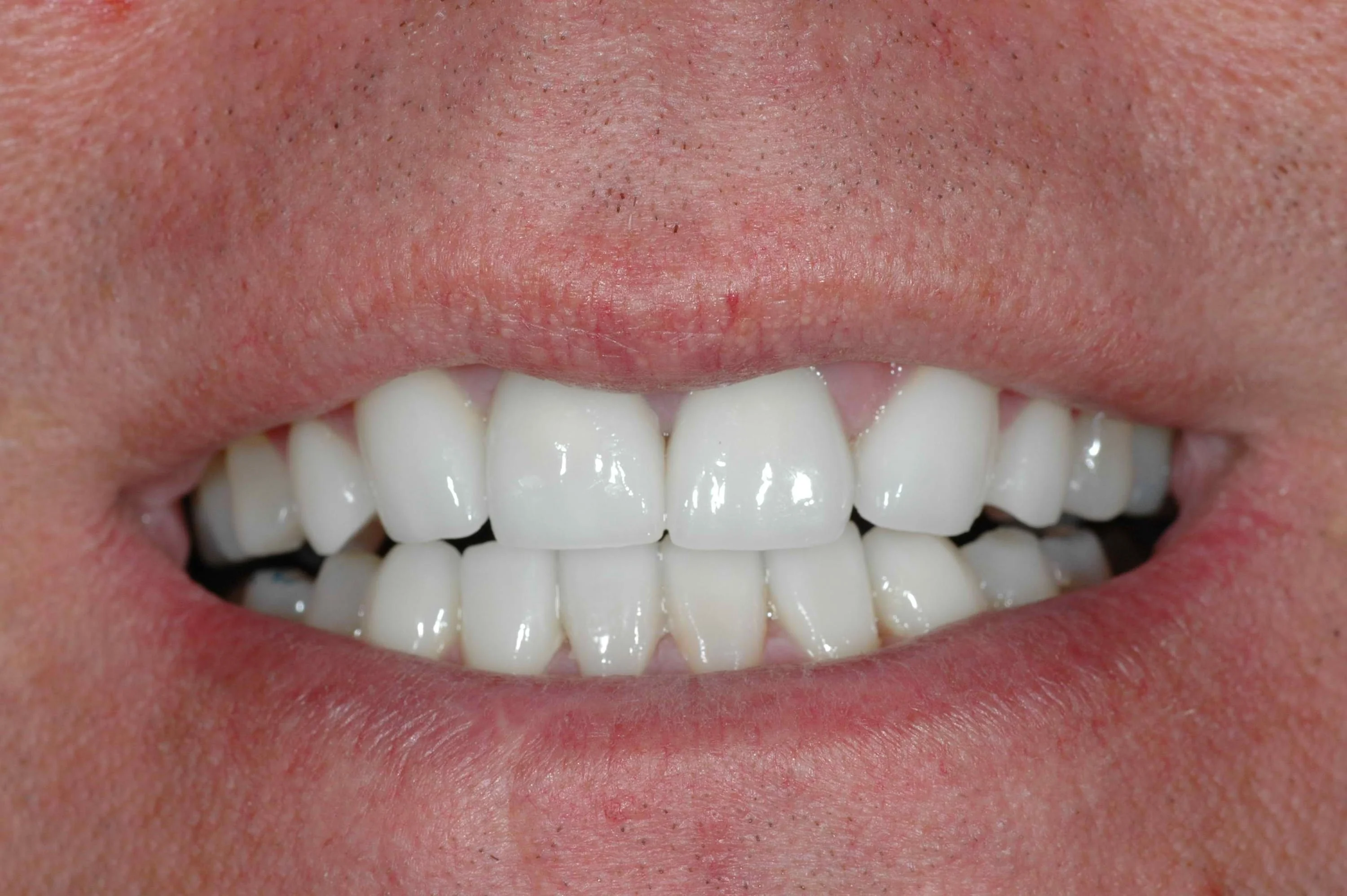 Cosmetic Dentistry McCandless Pittsburgh PA - after photo