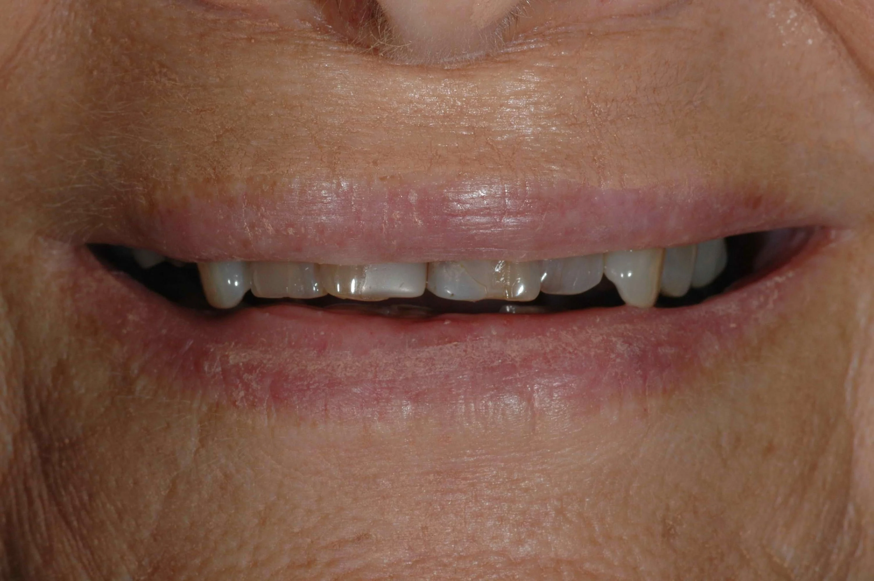 McCandless Cosmetic Dentistry - Before Photo