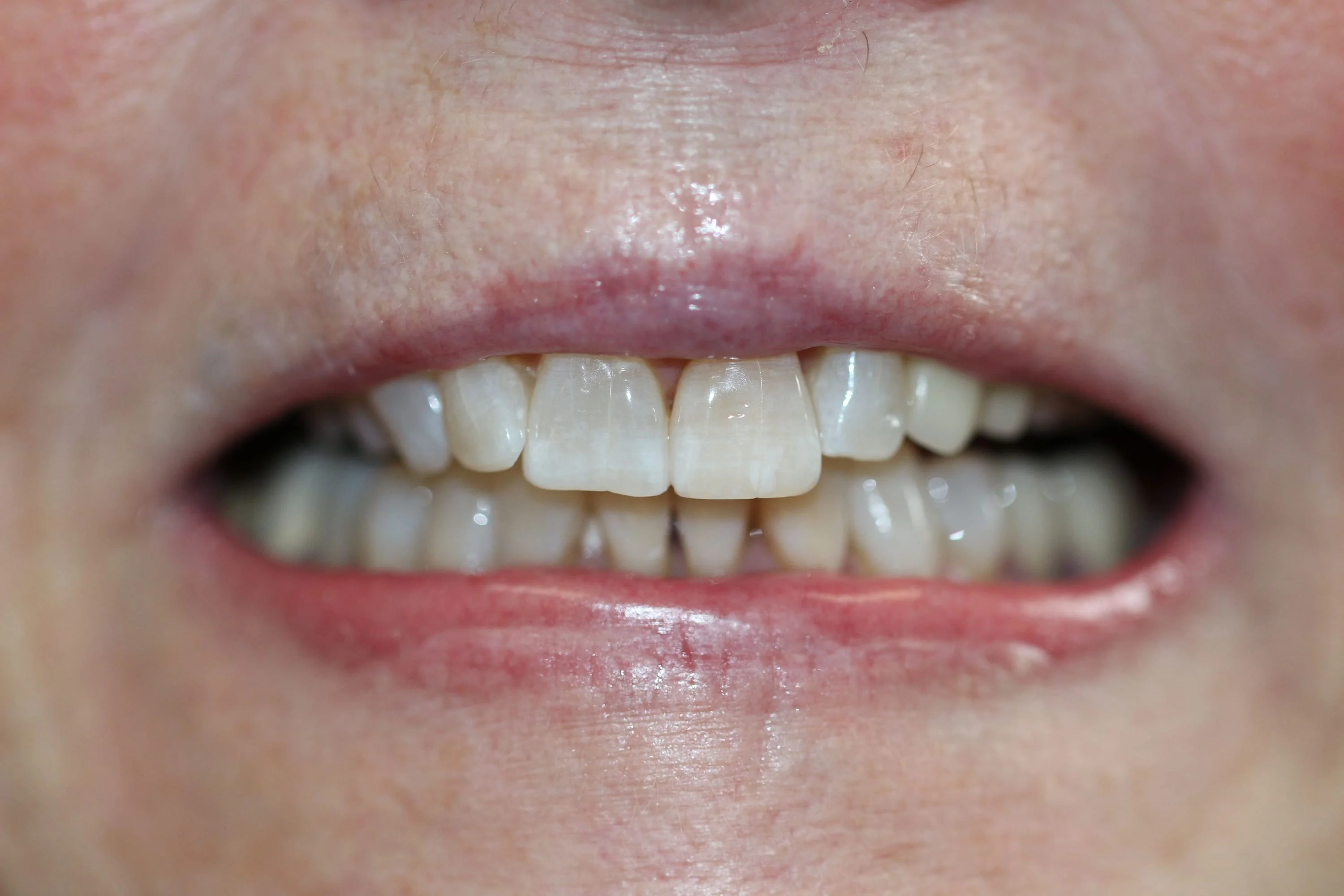 after Zoom Whitening