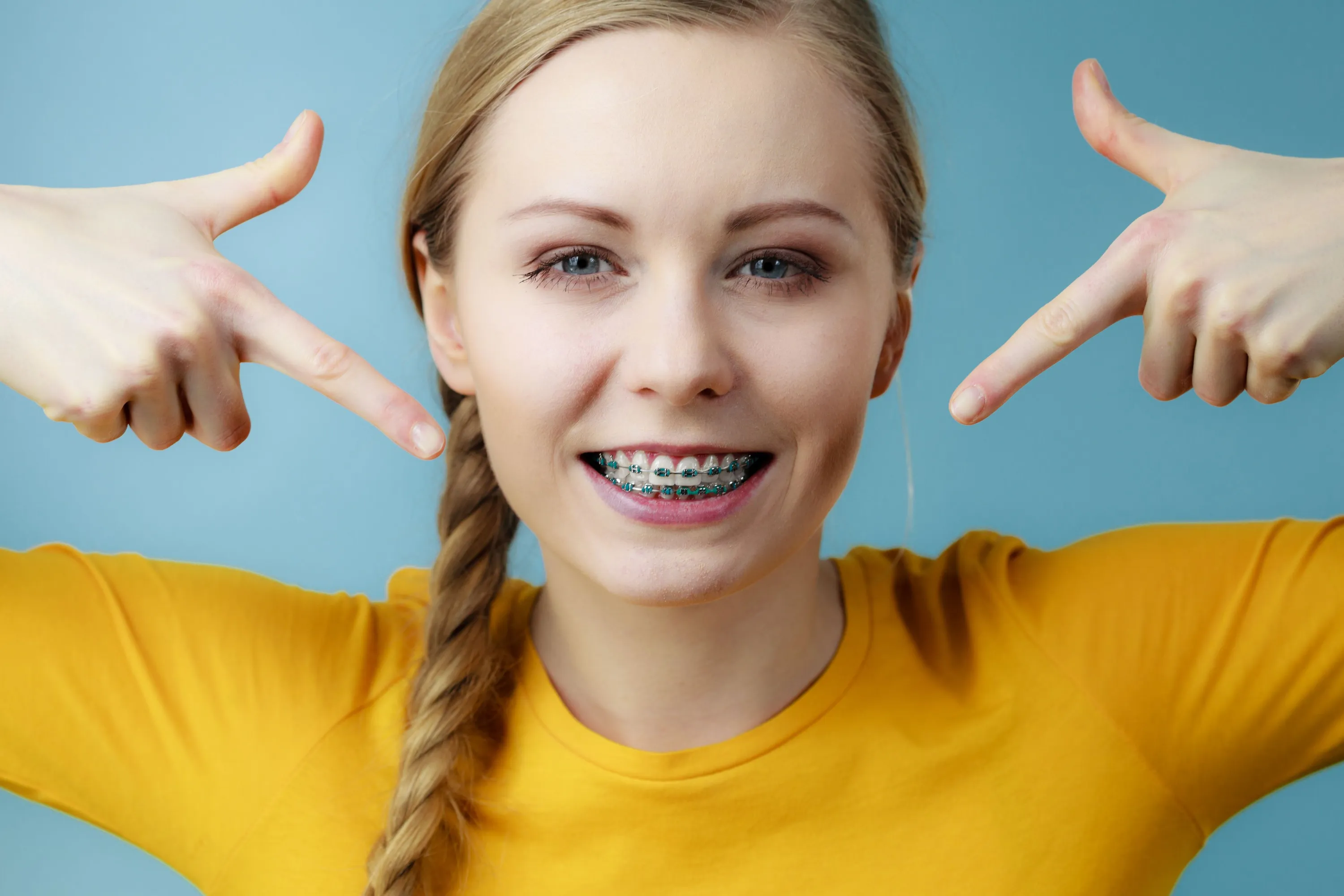 Blonde Braces