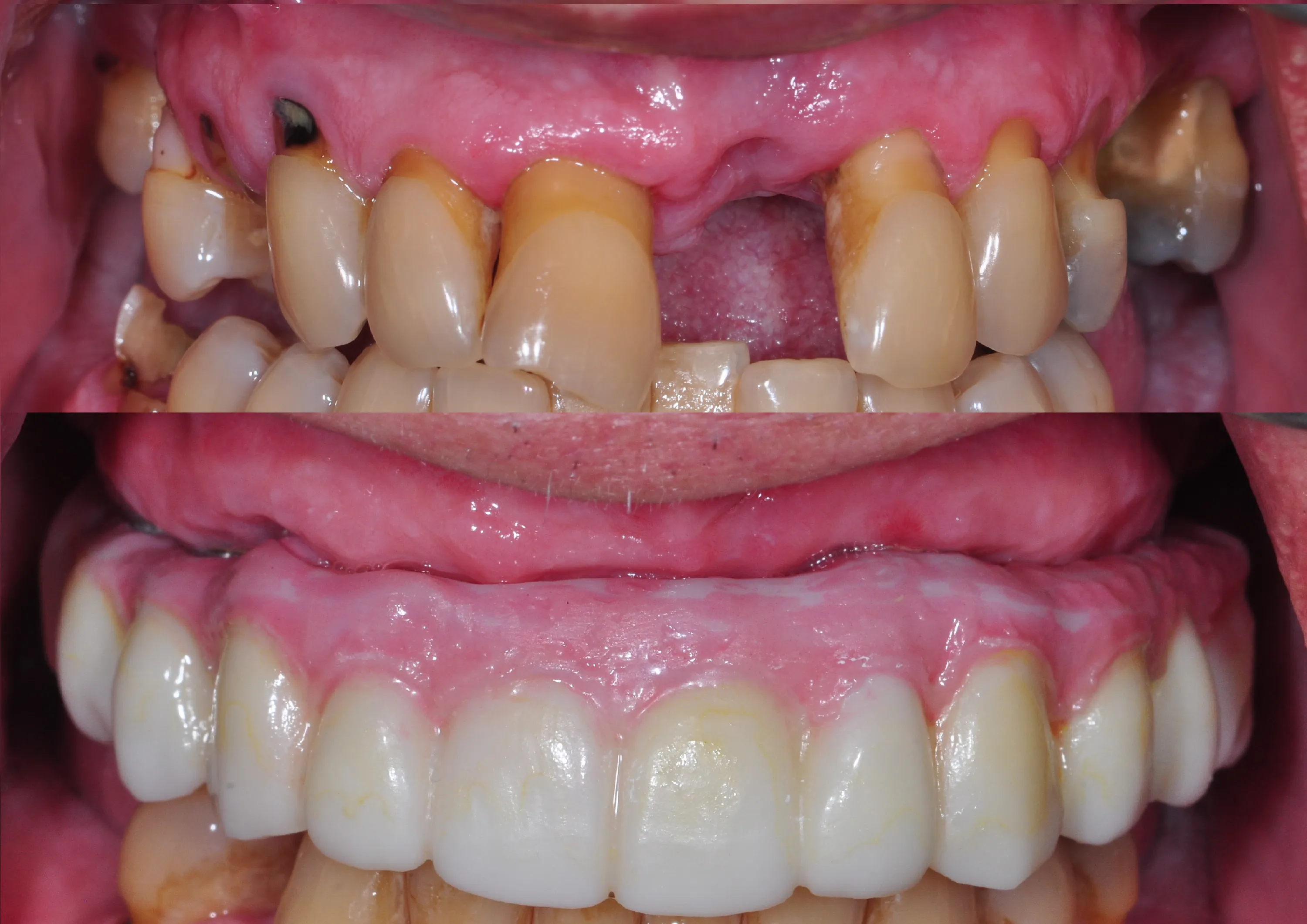 Upper Denture over Implants, Hybrid Prosthesis
