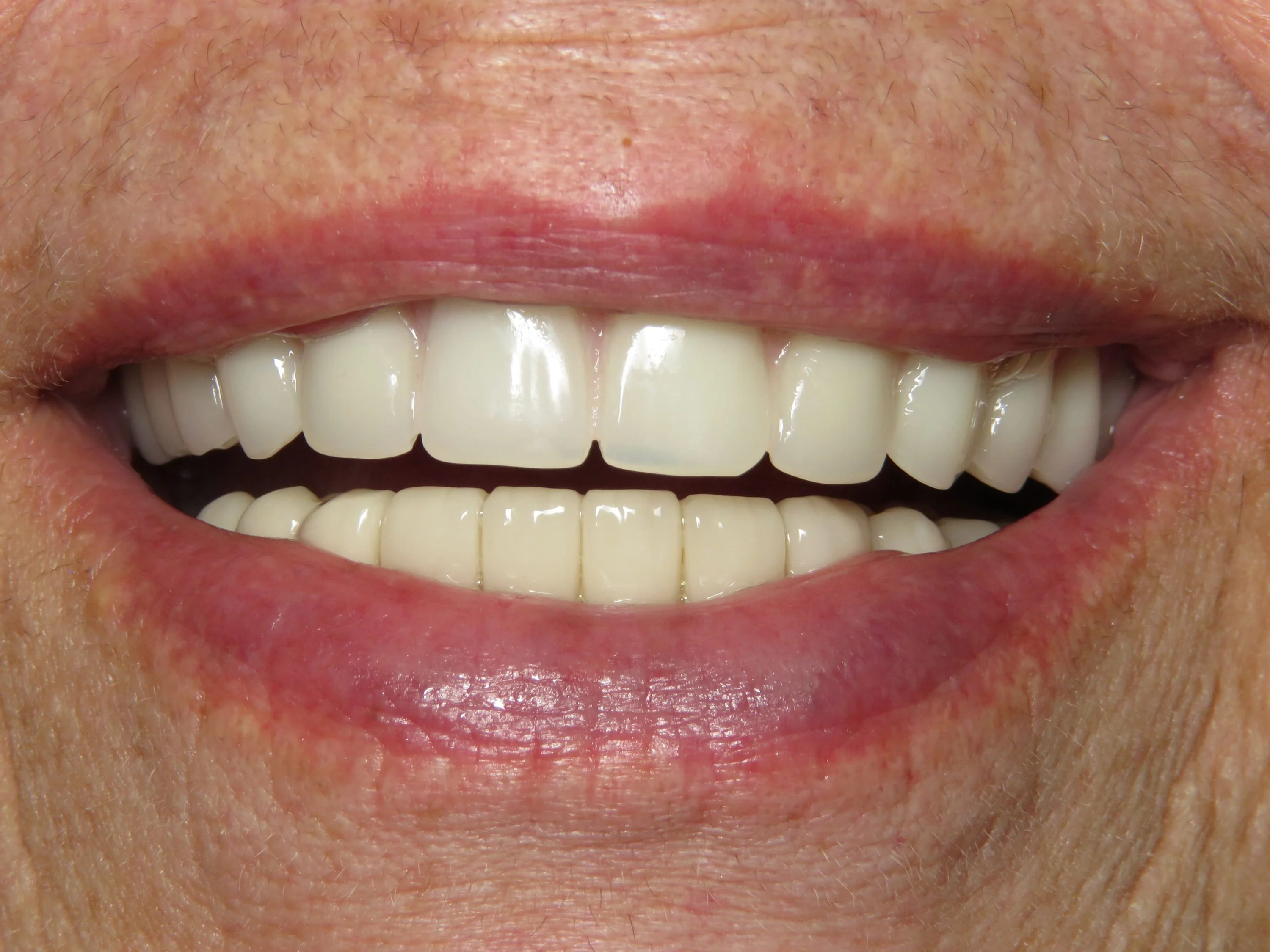 Upper Denture and Lower Crowns