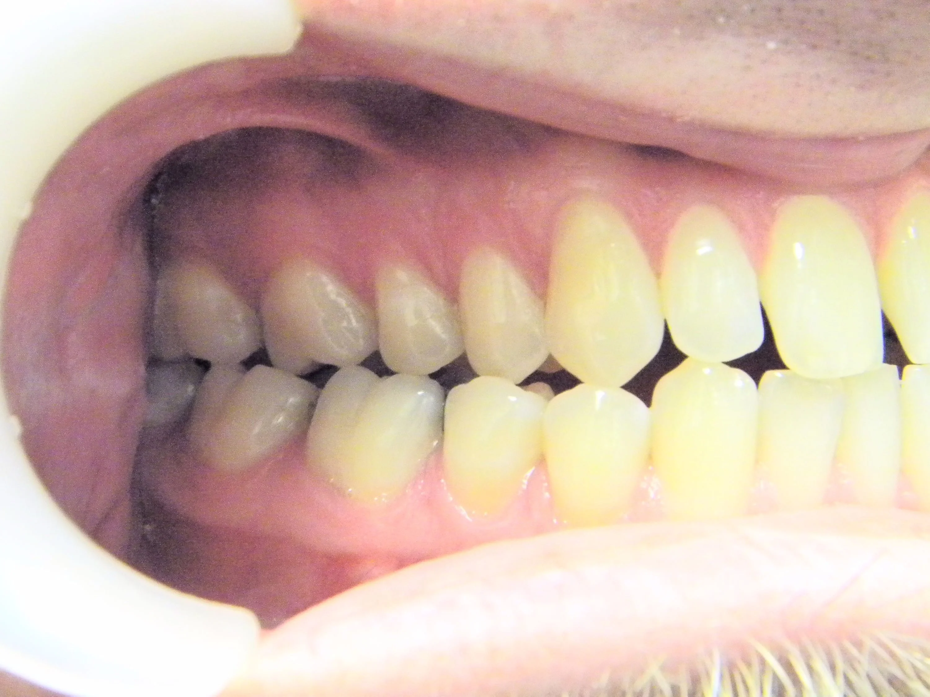 Before And After North York Veneers with Crowns
