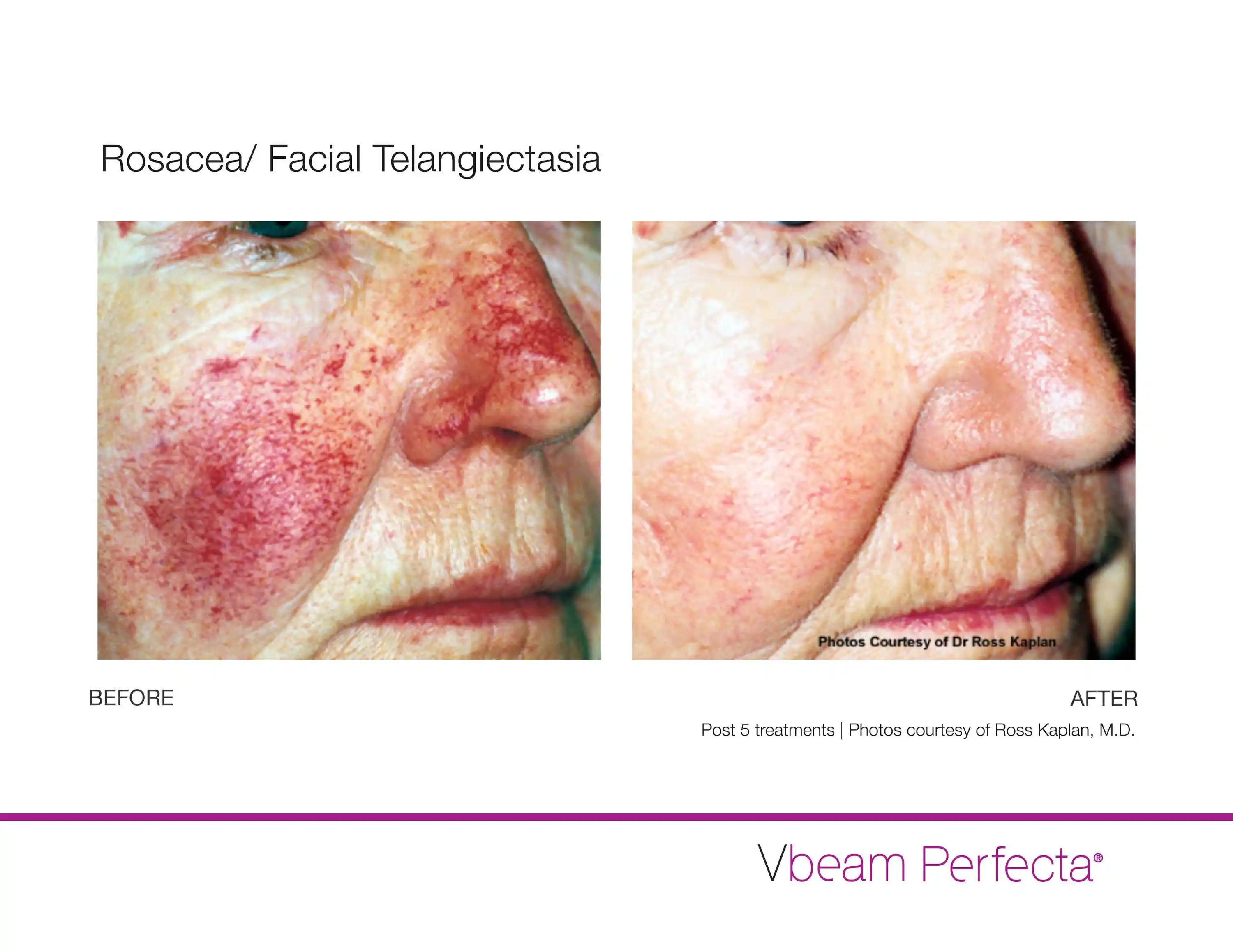 Before and After Vbeam