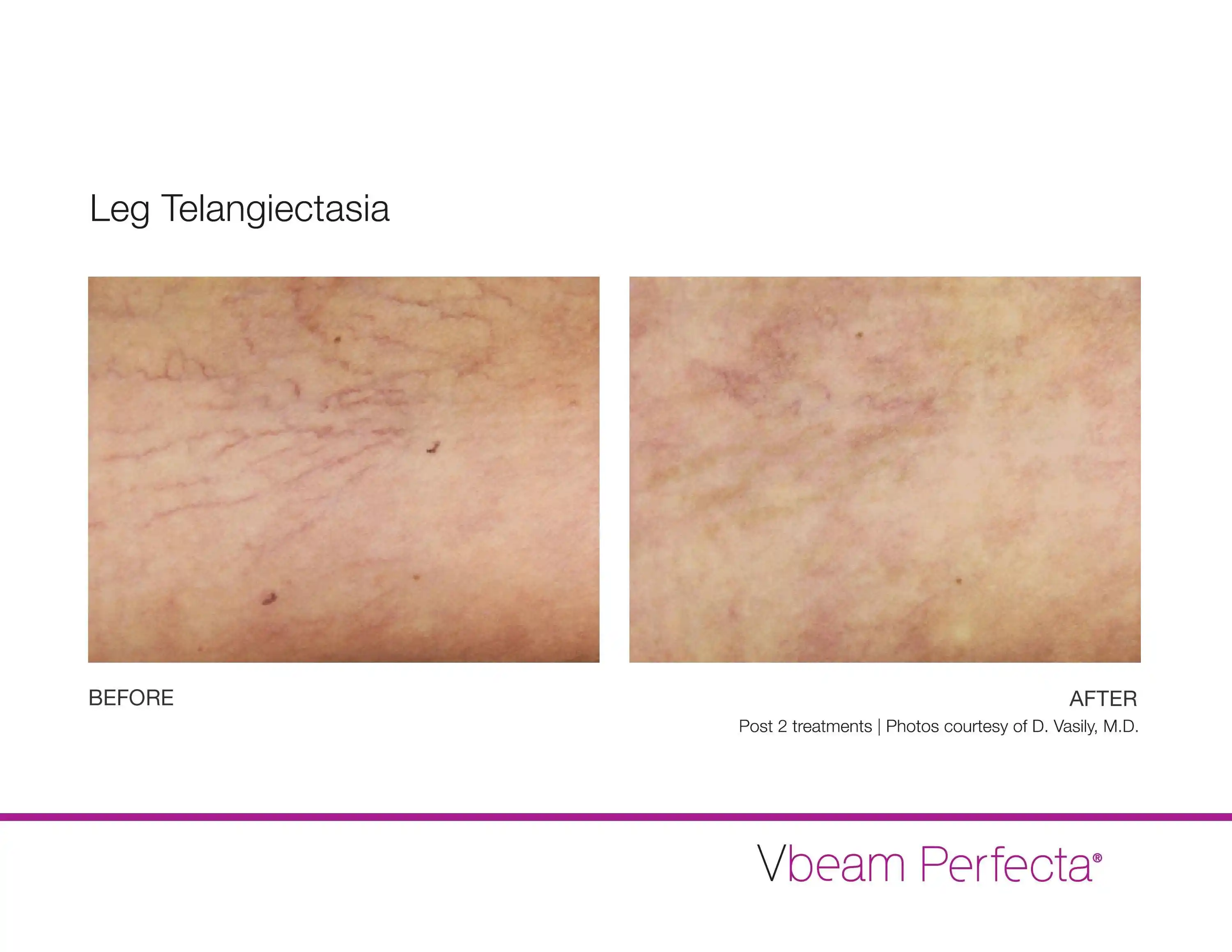 Before and After Vbeam