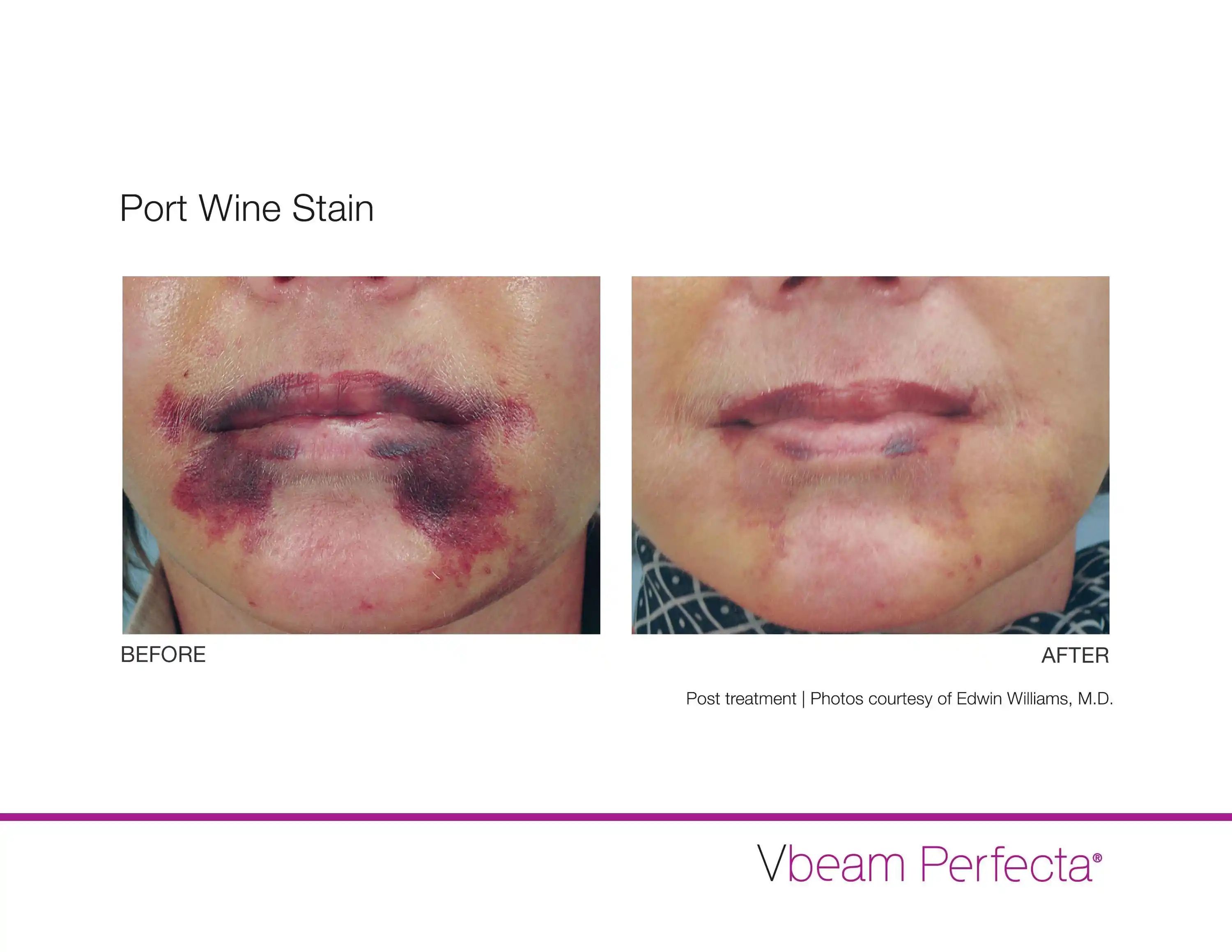 Before and After Vbeam