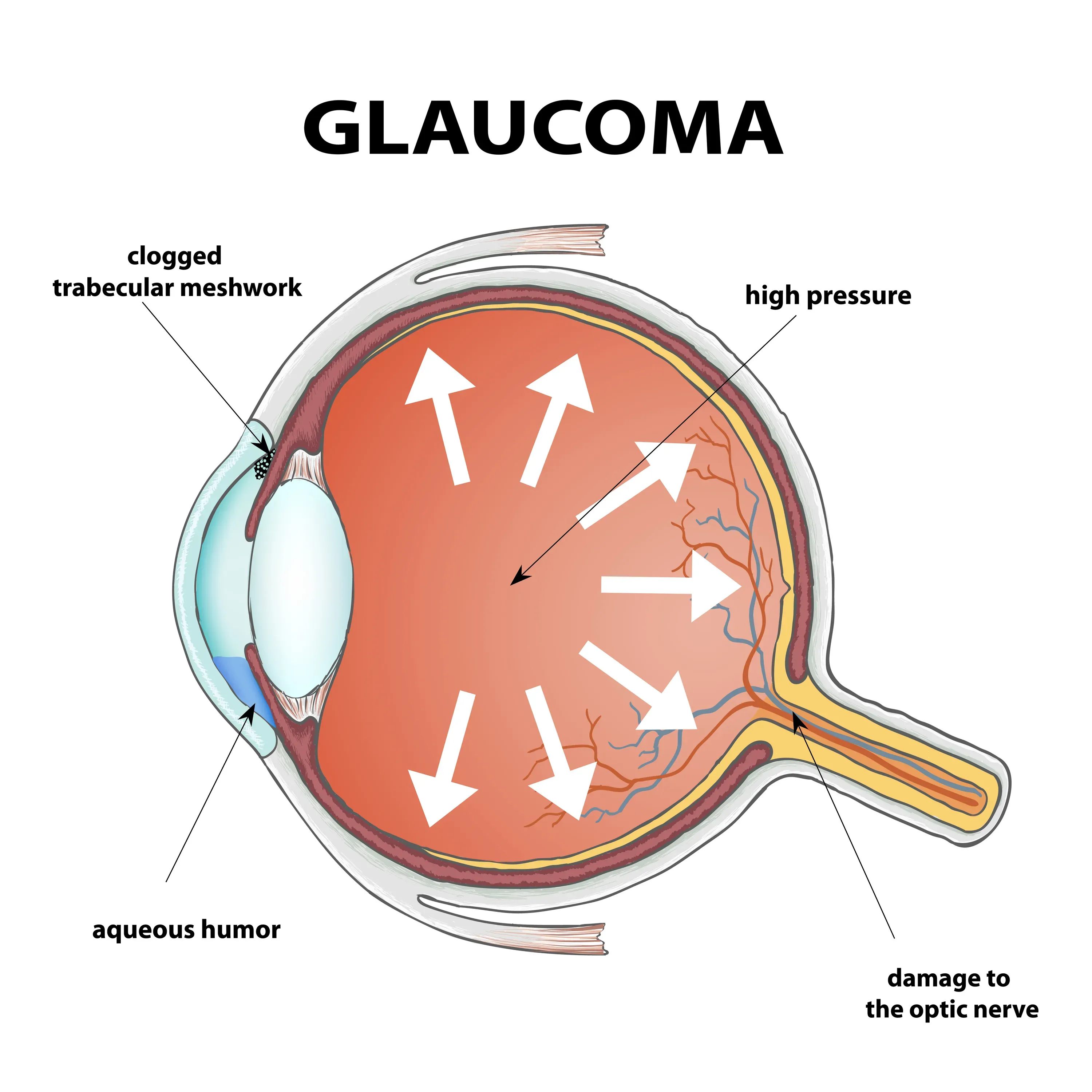 Glaucoma Eye