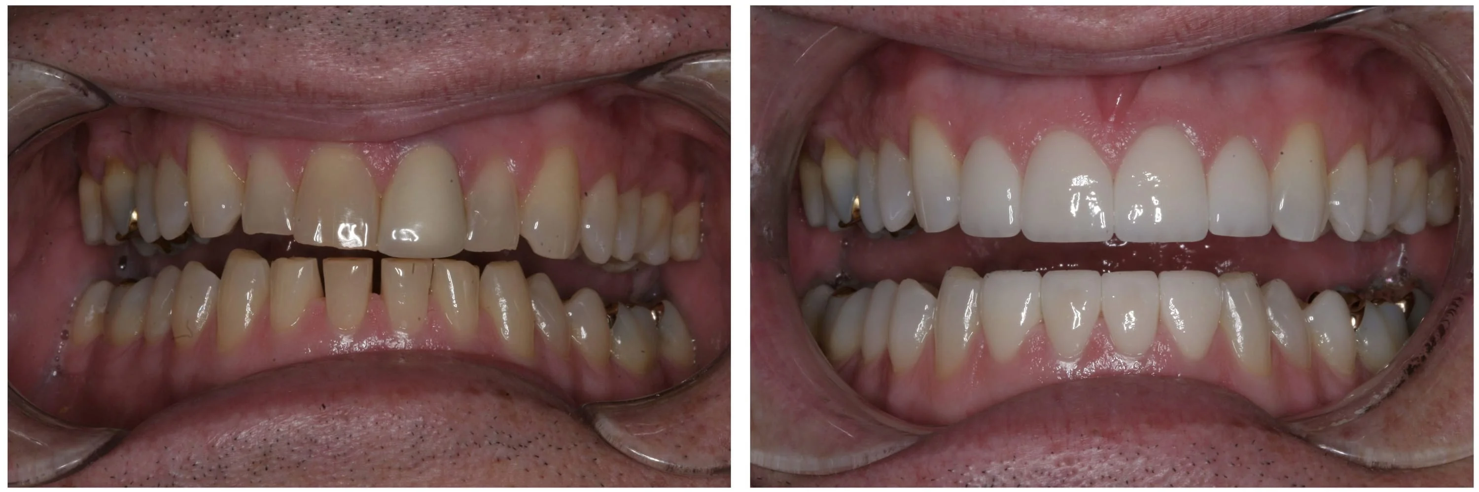 Teeth Whitening & Eight Crowns