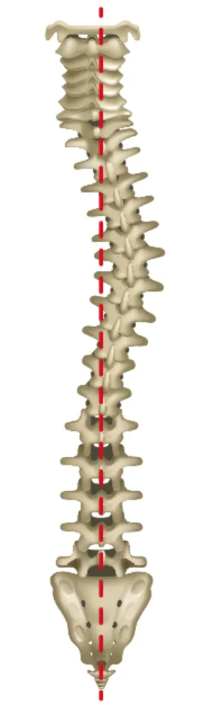 Dextroscoliosis