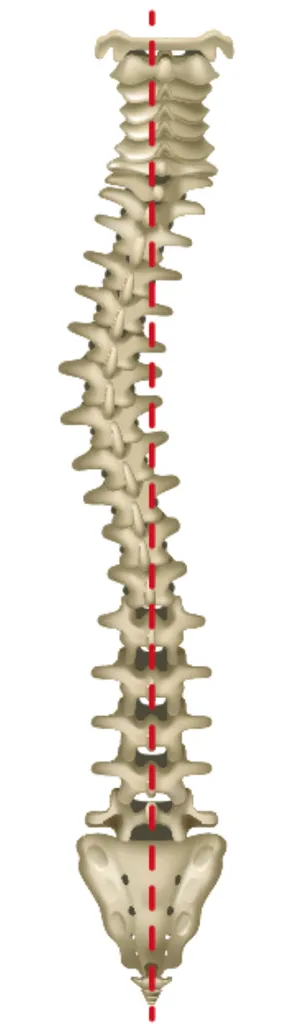 Levoscoliosis