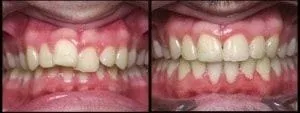 Misaligned_teeth.jpg