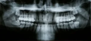Impacted Teeth | Lakeview Dental