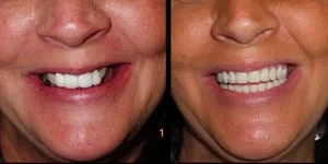 dental implants photos