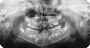 Dental Radiographs (X-Rays)