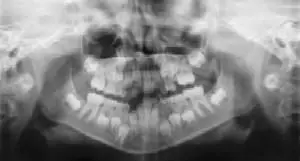 Dental Radiographs (X-Rays) - Pediatric Dentist in Temple, TX