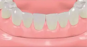 denture