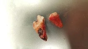 diseased tooth