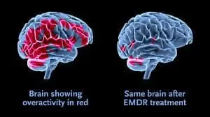 Image result for emdr brain before after