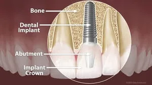 Dental Implant.