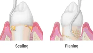 scaling-and-planing