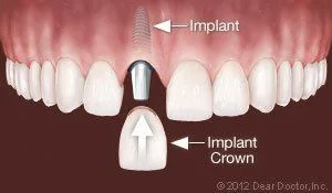 Dental Implants | Dentist In Addison, IL | Elite Dentistry