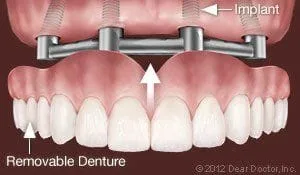 Support Removable Dentures