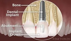 labeled illustration of embedded dental implants Lincoln, NE dentist