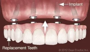 full arch of teeth is replaced with four dental implants Lincoln, NE implant dentistry