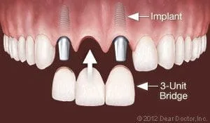 bridge replaces missing tooth over two dental implants Lincoln, NE implant dentistry