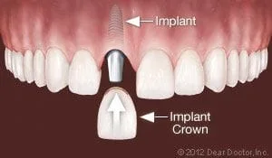 implant and crown replaces single tooth, dental implants Lincoln, NE dentist
