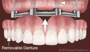 removable dentures attached to upper jaw with four dental implants Lincoln, NE family dentist