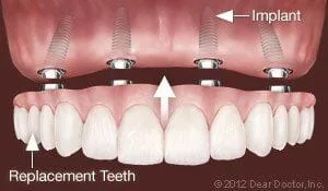 Replace All Teeth Permanently Lansing, MI dental implants
