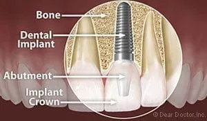 illustration of teeth and gums, interior view of embedded dental implants Decatur, IL